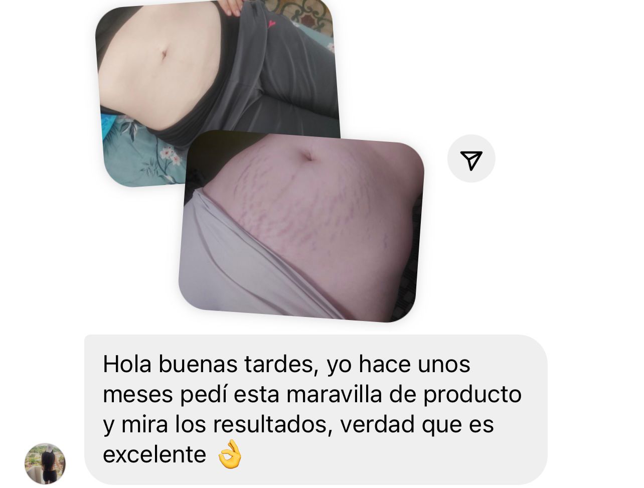 Kit estrias